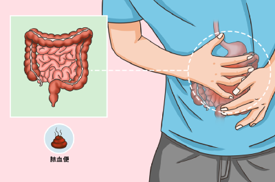 肠道里长了息肉，上厕所时会有3个提示，别等到中晚期了才发现
