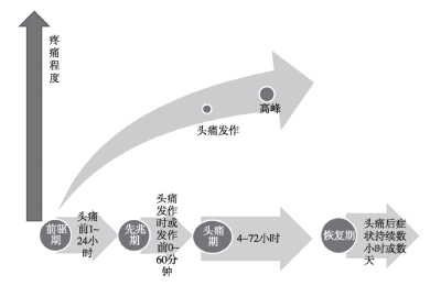 关于反复发作的偏头痛，走出这些认识误区