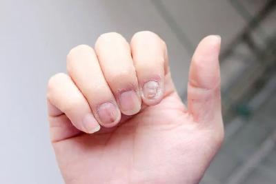 体内有癌，手指知道？提醒：手部若有3个异样，或是肿瘤侵袭了