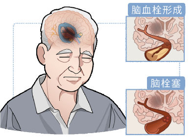 睡觉时若出现4种异常，当心是脑梗预警