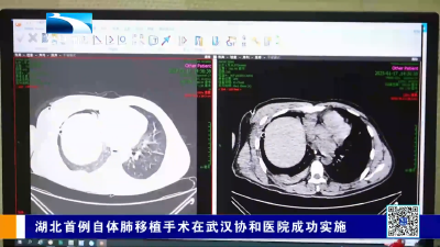 湖北首例自体肺移植手术在武汉协和医院成功实施