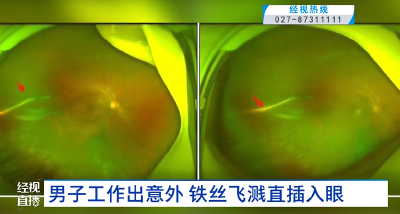 男子工作出意外 铁丝飞溅直插入眼