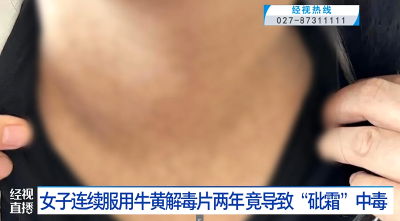 女子连续服用牛黄解毒片两年 竟导致“砒霜”中毒