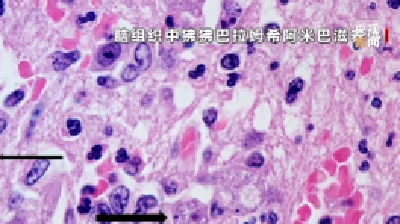 痛心！6岁男孩感染“食脑虫”去世