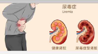 原来血液透析是这么回事！4个关键问题，帮你读懂生命守护技术 | 科普时间