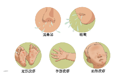怕娃中招？手足口秋季防护家长必看