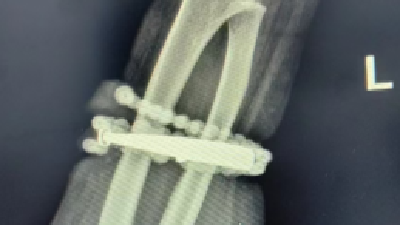 女子手镯10年没摘竟“长”进肉里！医生：再迟就保不住了