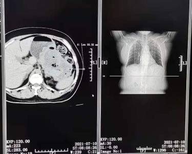 房县人民医院：双科联手 成功实施腹腔脓肿经皮穿刺置管引流术