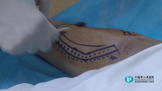 患者血透“生命线”被成功打通！十堰这项新技术能救命！