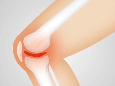 招募！膝关节疼痛患者免费治疗！还有补贴！