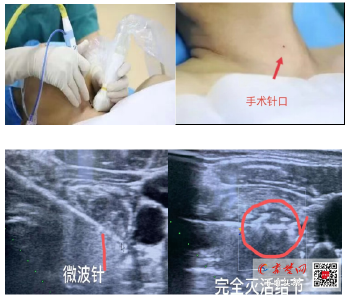 高质量技术看人医 | 十堰人医甲状腺乳腺血管外科2病区微波消融术治愈甲状腺结节精准不留疤