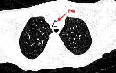 太惊险！十堰老人吃了口它，命悬一线！医生提醒