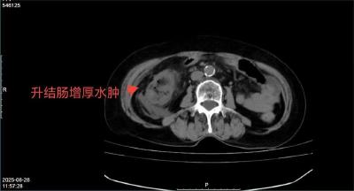 房县人民医院：多学科联手共破 “死亡之征”！