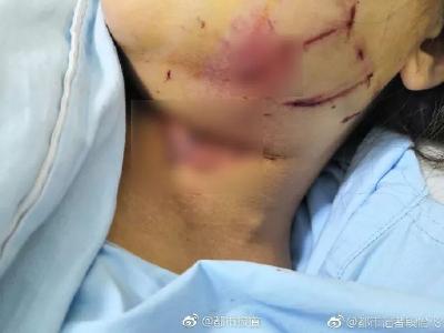 婚礼现场突发爆炸，1死11伤！当心婚礼上的这样东西...
