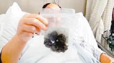 吃一周柿子会咋样？胃里长出4颗结石差点要了他的命