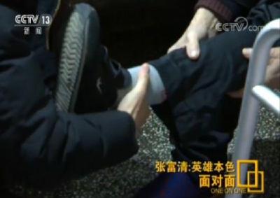 张富清：身残志坚 年逾八旬截肢 自己锻炼用义肢走路