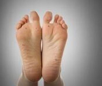 男子脚碰热水就会痛 只因脚趾下藏着一颗瘤