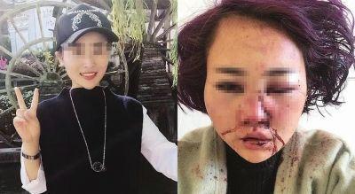 丽江被打毁容女子鉴定为轻伤 当事人：我如何能接受