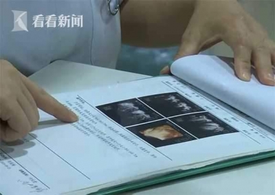 罕见！22岁女子婚前体检 卵巢里竟发现大量毛发和骨头