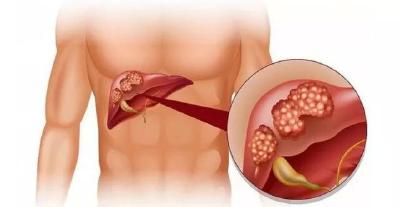 39岁男子肝癌离世，医生这样说