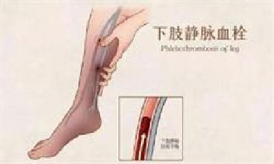 患者突发下肢肿胀疼痛一查是下肢血栓 不开刀溶栓中西结合治疗化险为夷