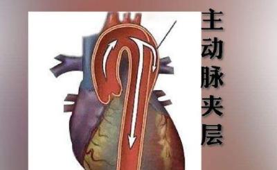 十堰人医心胸大血管外科因人施术 一天救治两例主动脉夹层患者