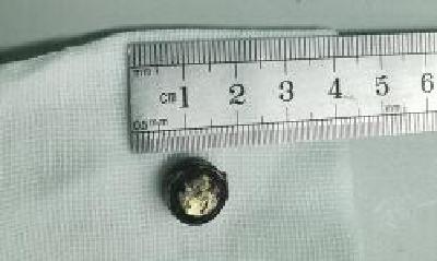 家有小孩要注意！两岁女童将纽扣电池塞入鼻腔，被腐蚀穿孔！