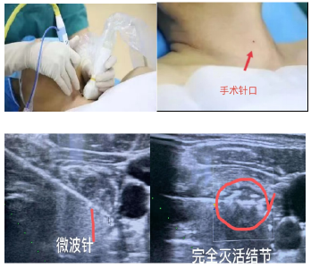 高质量技术看人医 | 十堰人医甲状腺乳腺血管外科2病区微波消融术治愈甲状腺结节精准不留疤