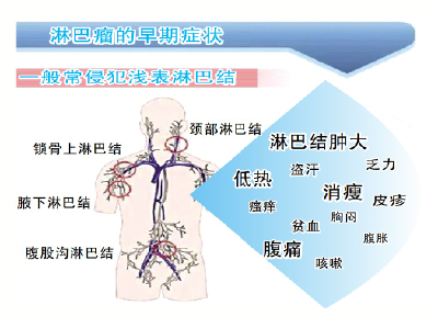 65岁以上人群淋巴瘤发病率增长最快 三个部位有肿块要警惕