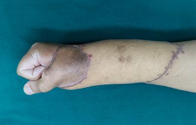 太和手指缺损全形再造技术让患者缺失的手指完美“复原”