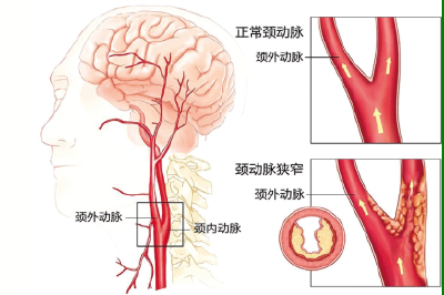 头晕肢体麻木 当心颈动脉狭窄