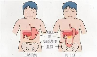 太和医院脏腑推拿为胃下垂患者带来新希望