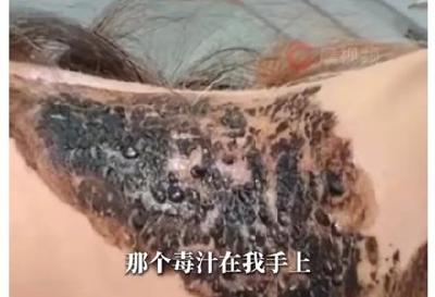 有人因此“毁容”！遇到这种虫子千万不能拍