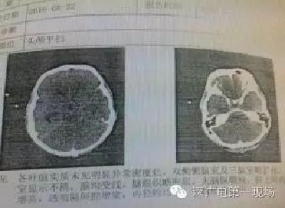 男子染“食脑虫”十几天后不治 提醒：避免到池塘游泳