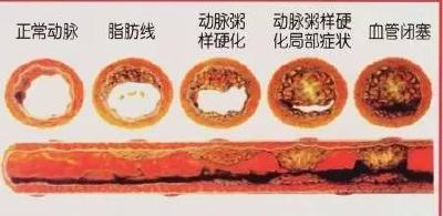 【健康】血管就是这么一天一天被堵死的，这个进程我们现在才知道！