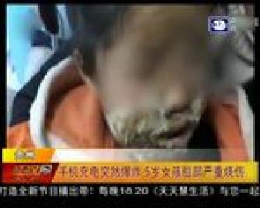 手机充电突然爆炸 5岁女孩脸部严重烧伤
