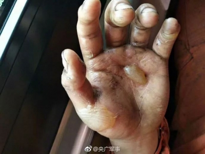 这只手的照片，让15万网友点赞，无数人心疼…