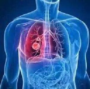 好消息！公安县成立人工智能（AI）肺癌早筛中心