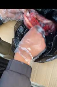 暗访胎盘黑市
