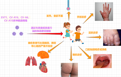 荆州进入手足口病流行高峰，请注意防范！