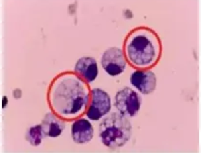 00后女演员确诊“癌王”！崩溃痛悔：大家别像我这样