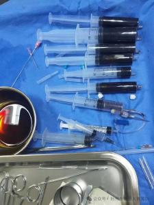 “小针”解“大病”——超声介入治疗甲状腺巨大囊肿