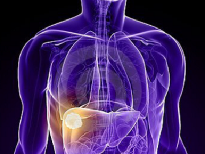 湖北省体检人群健康白皮书发布 三成受检者患有脂肪肝