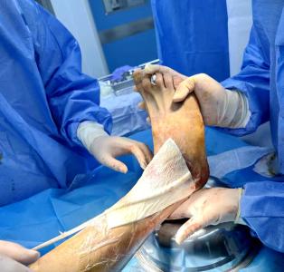 油锯割伤足险废！一台高难度手术“抢”回希望