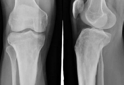 市中医医院骨二科成功开展首例颈椎后路手术 创新技术为患者谋福利