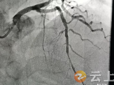 胡集镇中心卫生院首次实施“溶栓+转运PCI”成功救治患者