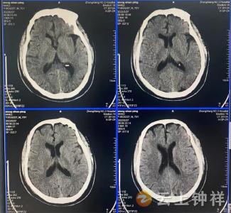 胡集镇卫生院第一例急性脑梗死溶栓成功