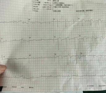 冷水镇卫生院成功实施首例急性心肌梗死静脉溶栓+转运PCI