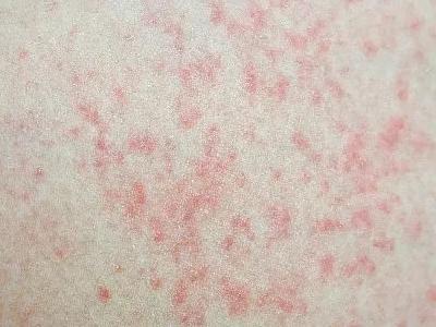踏春出游后出现发热、皮疹，小心是这种急性传染病！ 