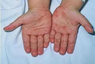省卫健委刚刚发布！这些病进入高发期！提醒身边人！